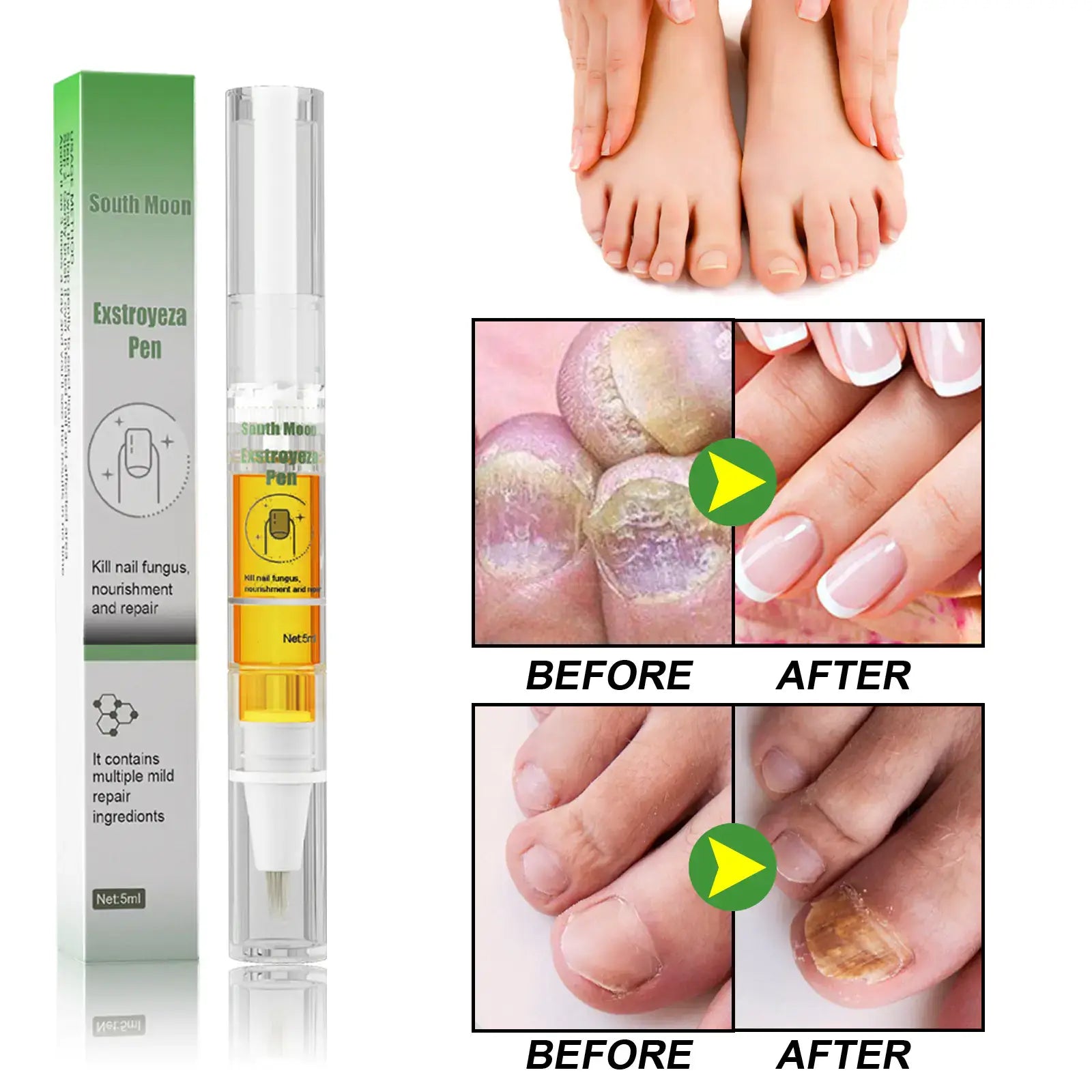 South Moon Nail Care Repair Liquid for Healthy Nails showcasing before and after results of nail treatment with Exstroyeza Pen.