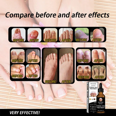 EELHOE Nail Repair Solution, Thickening And Brightening Nails