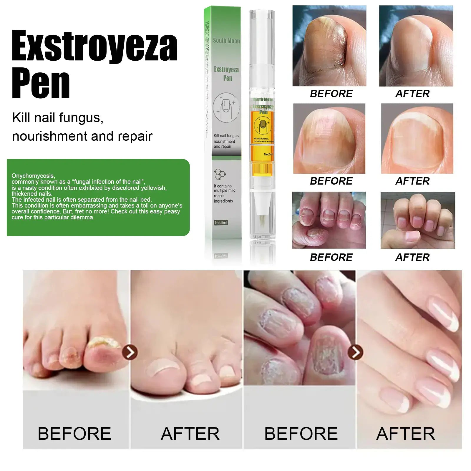South Moon Nail Care Repair Liquid for Healthy Nails before and after results with Extroyza Pen for nail repair